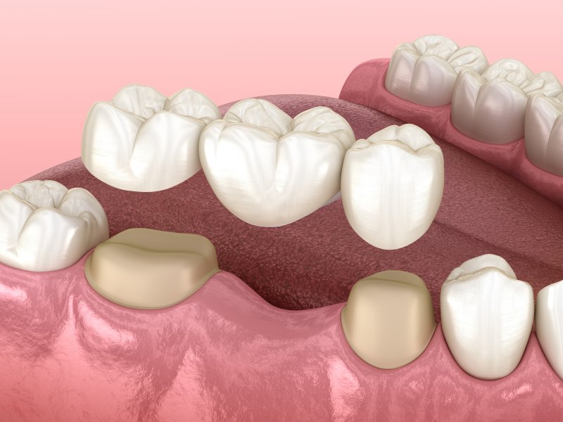 dental crown & bridge